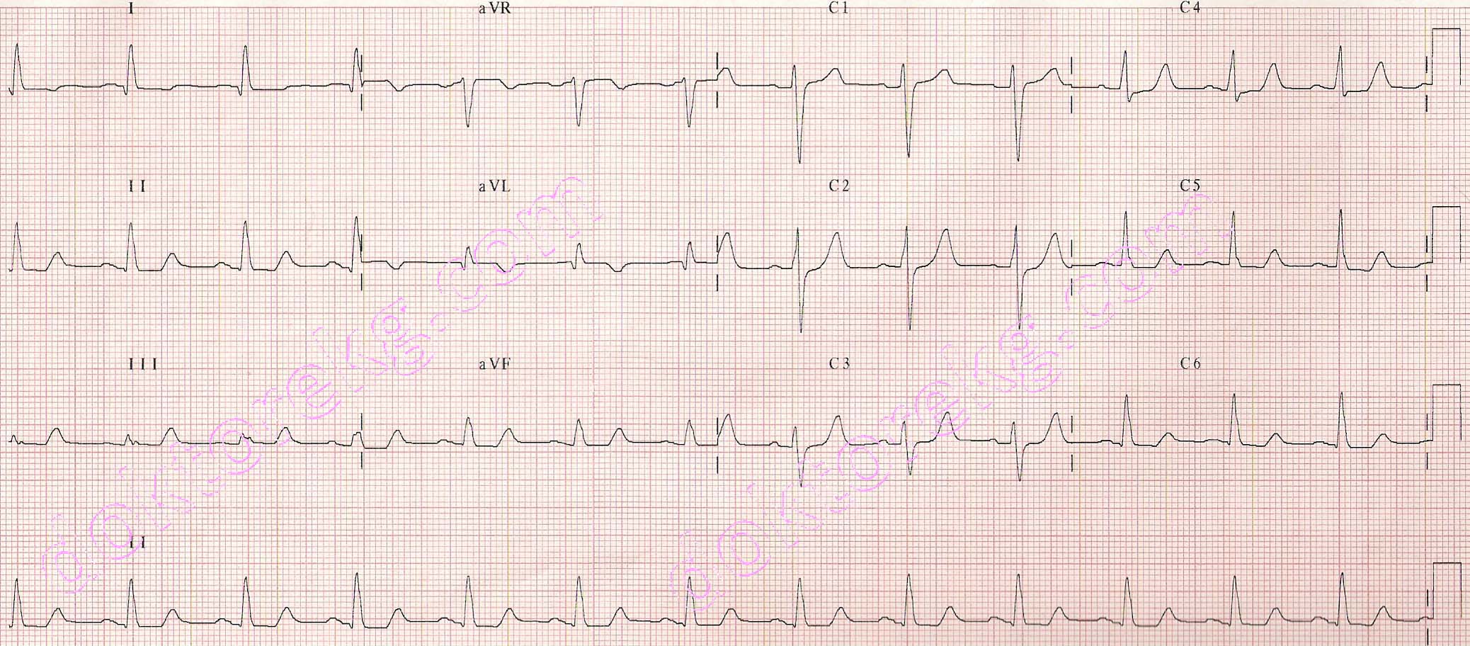 Non-ST Elevation Myocardial Infarction - ekg - ecg - diyarbakır ...
