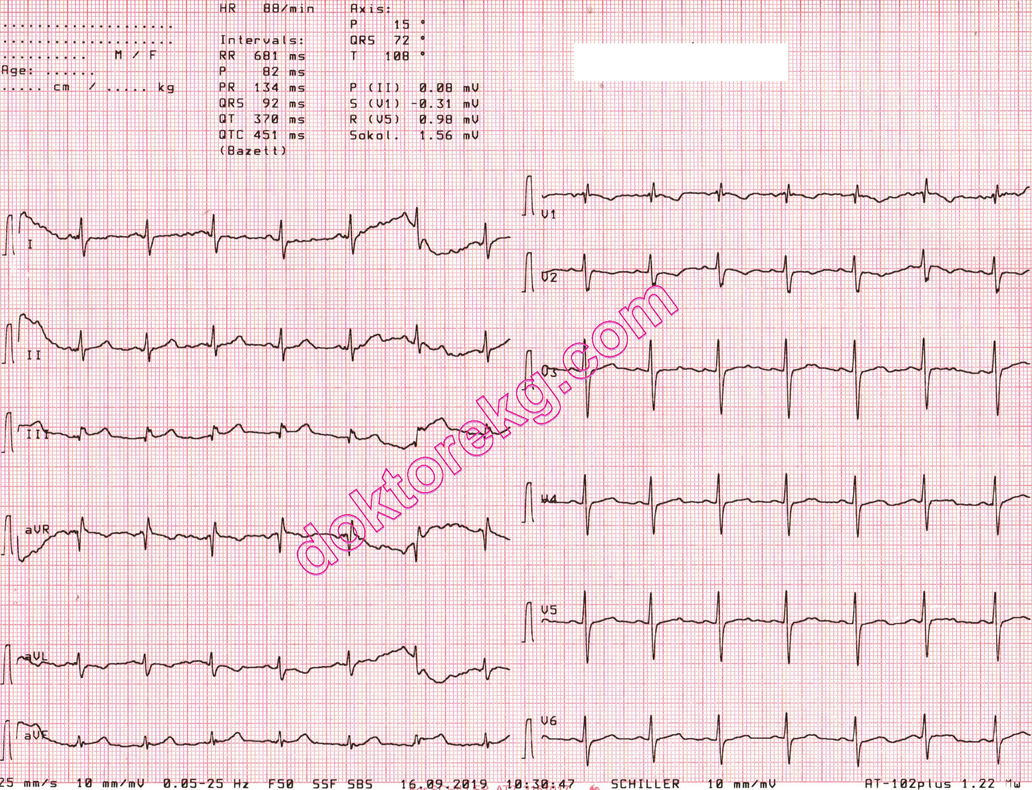 crochetage sign, 26 years after surgical closure of ostium secundum asd ...