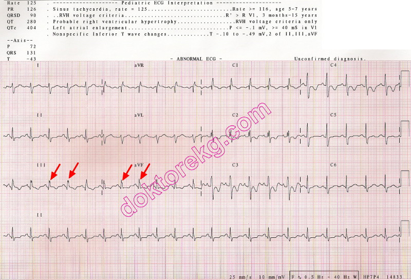 crochetage sign - atrial septal defect (asd) - vsd - ekg - ecg ...