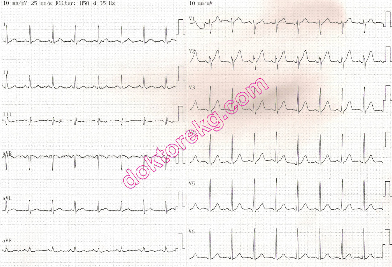 crochetage sign - atrial septal defect (asd) - vsd - ekg - ecg ...